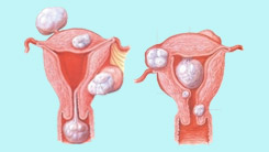 子宫肌瘤