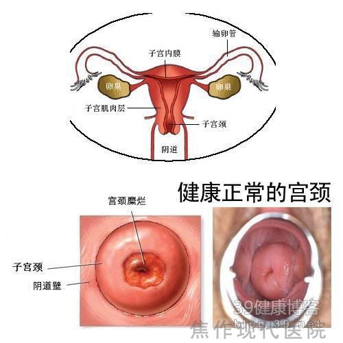 女性宫颈糜烂，及时有效的治疗是关键！