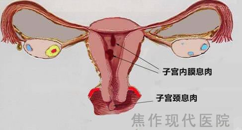 金州治疗宫颈息肉要花多少钱？