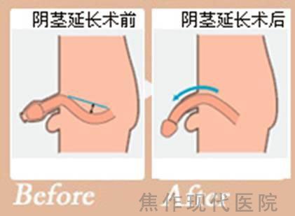 阴茎短小 差点继送了他的幸福