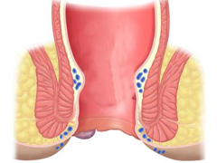 金州常见的痔疮症状是什么?