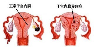 子宫内膜异位症的“祸害”你知多少？