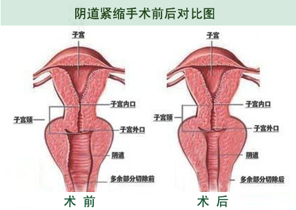 <strong>阴道紧缩术 让你做回紧致女人</strong>