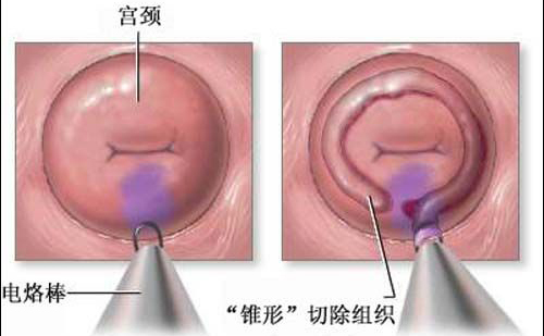 <strong>形成宫颈囊肿的原因是什么?</strong>